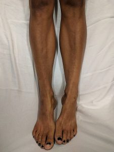 Photograph of a woman's legs showing hyperpigmentation from Addison's disease.