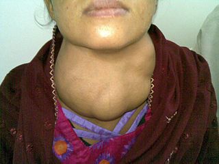 Photograph of a woman with a goiter.