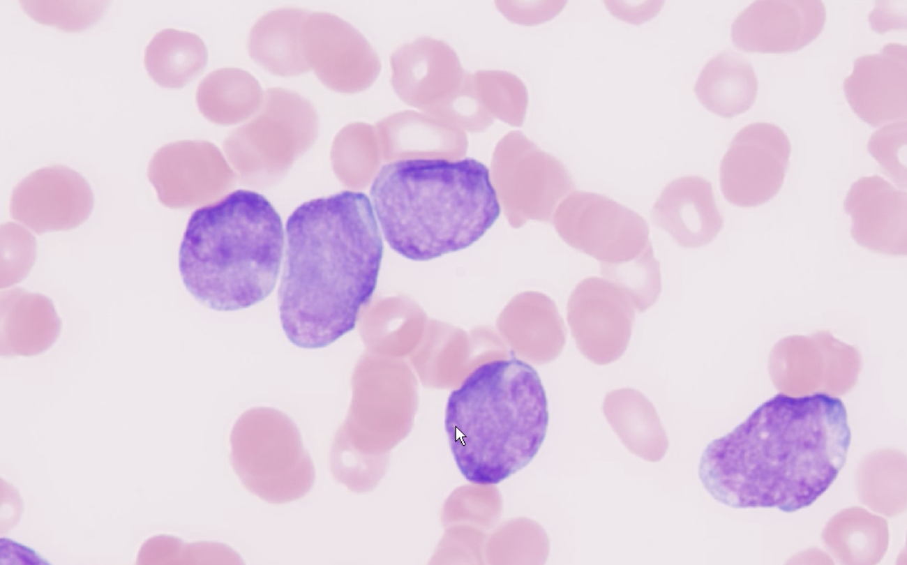 Photomicrograph of stained white blood cells from a patient with chronic myeloid leukemia.