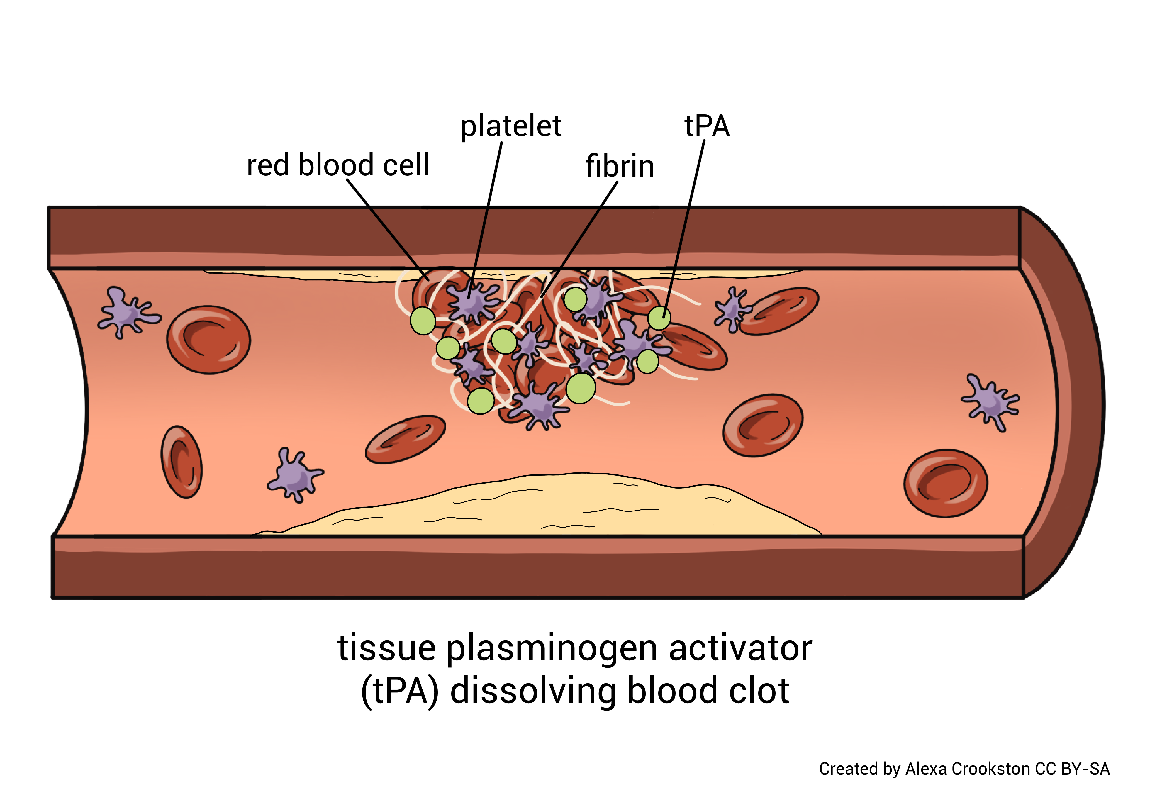 Diagram showing a blood clot dissolved by tPA.