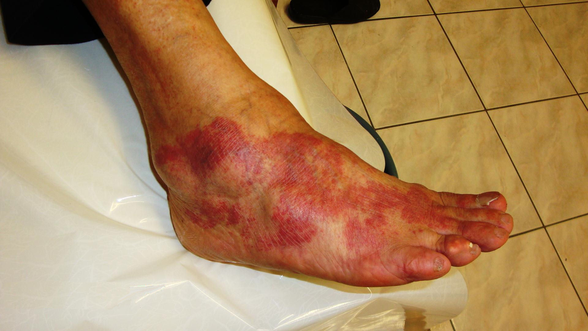 Photograph showing an inflammatory reaction to an antibiotic.