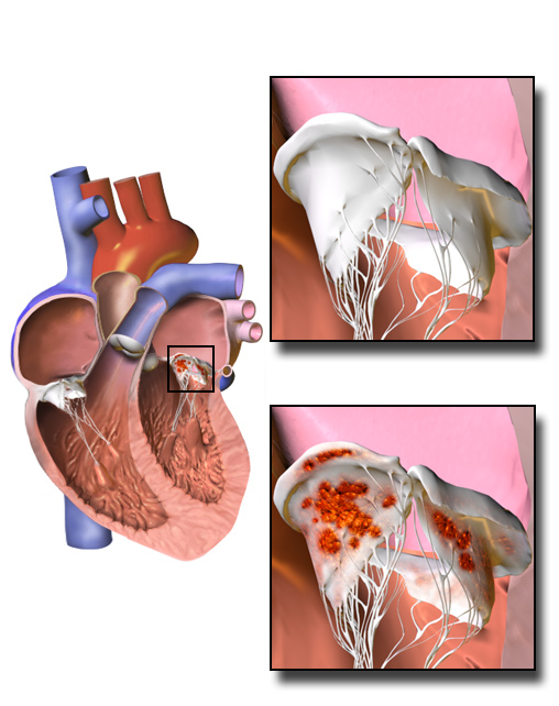 Diagram showing vegetations on the valves of the heart in endocarditis.