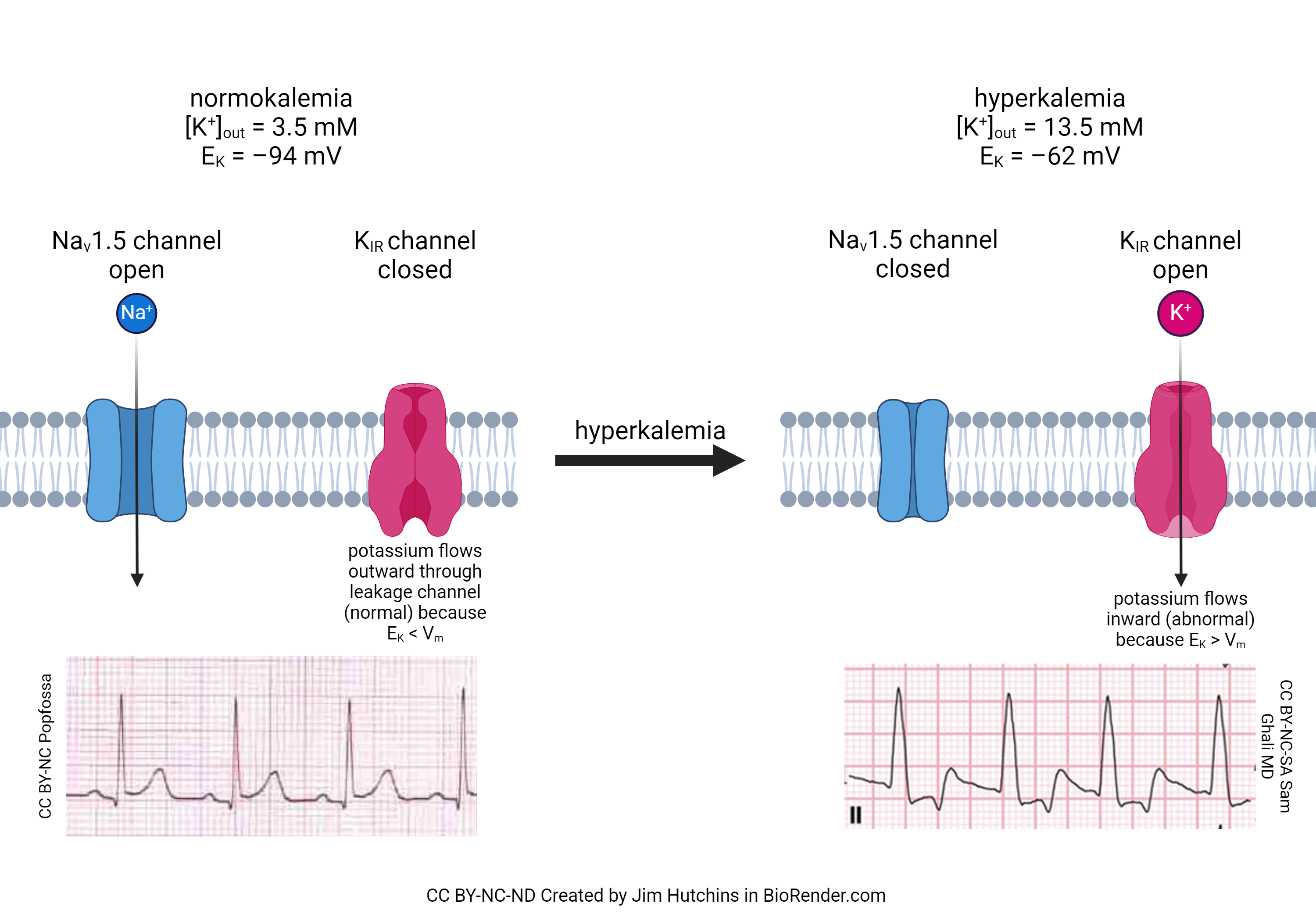 Diagram showing the effects of hyperkalemia on the flow of ions and the ECG.