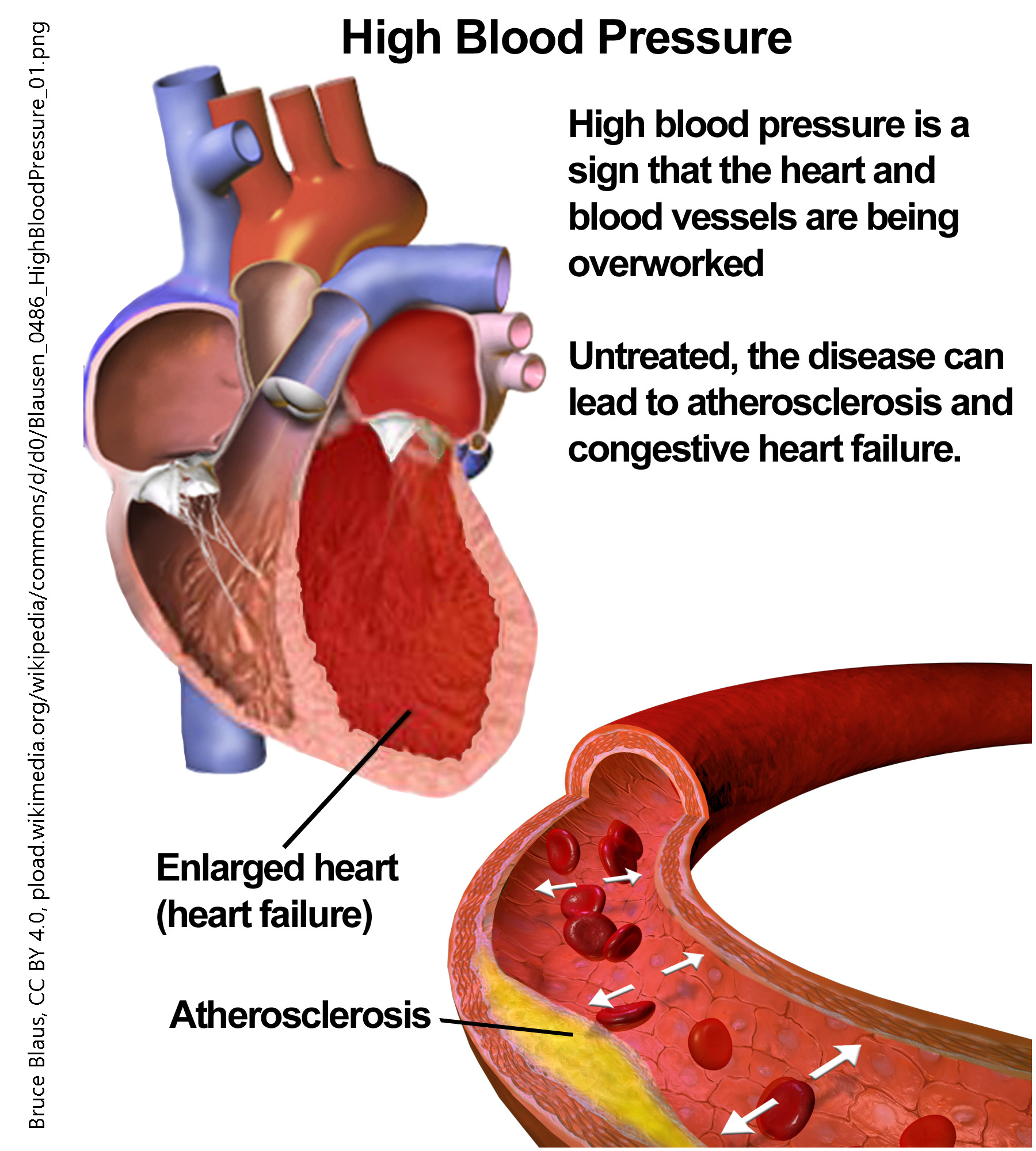 Diagram showing the mechanisms of disease in hypertension.