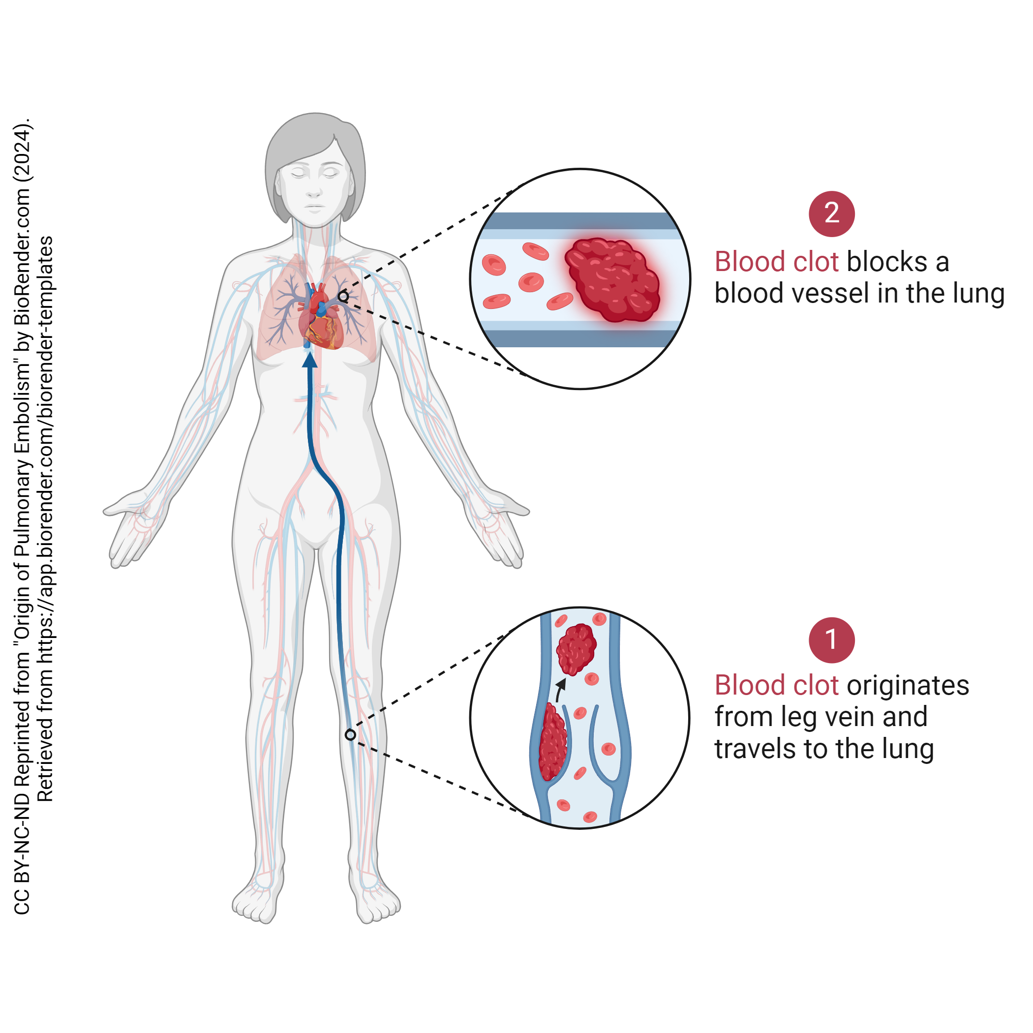 Diagram showing the mechanism of pulmonary edema.