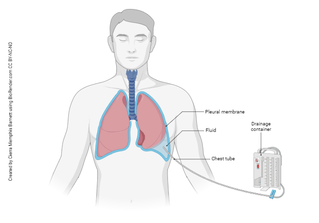 Diagram showing the sequelae of pleural effusion.