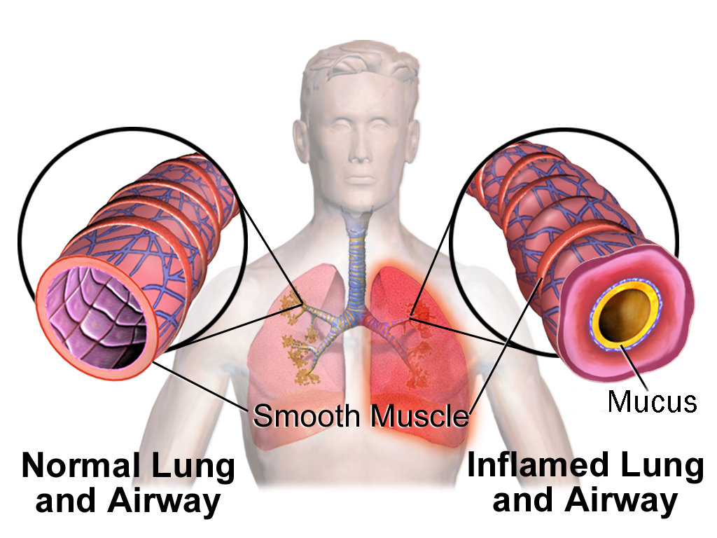 Diagram showing inflammation in the airways.