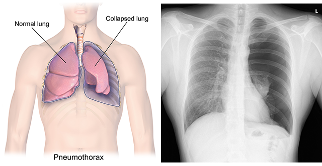 Composite image showing a diagram and X-ray of a pneumothorax.