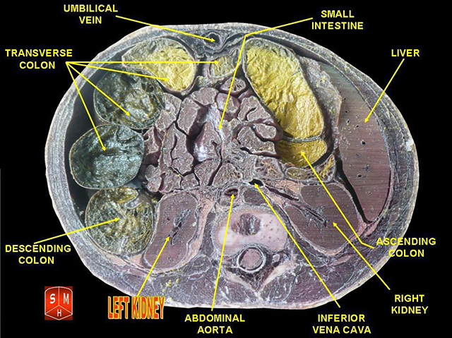 Photograph of a horizontal section of the human abdomen showing the location of the kidneys.