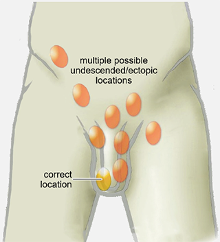 Diagram showing several different forms of cryptorchidism.