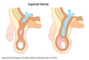 Diagram illustrating the pathology of an inguinal hernia.