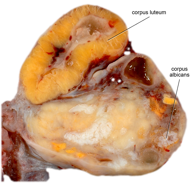 Photograph of an ovary showing a corpus luteum and corpus albicans.