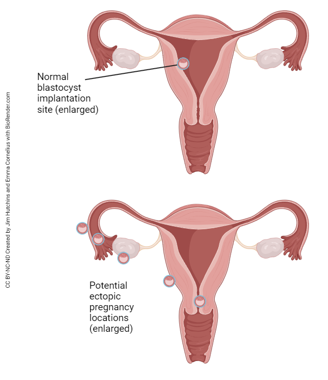 Diagram showing potential locations for ectopic pregnancies.