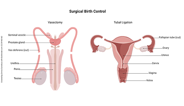 Diagram showing methods of surgical birth control.